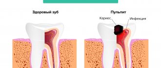 Поражение пульпы зуба в картинках