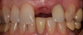 Постэкстракционные лунки однокорневых зубов: классификация и протоколы восстановления