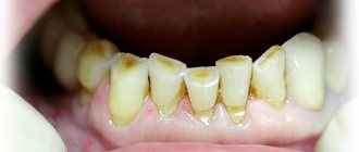 повышенное истирание зубов