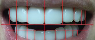 Процедура реставрации зубов