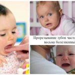 Прорезывание зубов часто бывает весьма болезненным