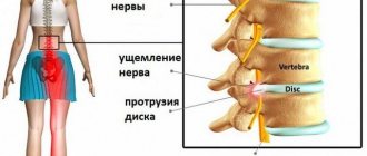 Протрузия может долгое время не проявлять себя, но, несмотря на это, развиваться