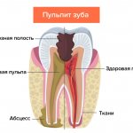 Pulpitis of the tooth in pictures