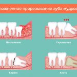 Различные заболевания, требующие удаления или лечения зуба мудрости.
