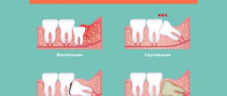 Various diseases requiring removal or treatment of wisdom teeth.