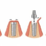 Types of one-stage implantation