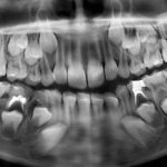 Рентген молочных зубов