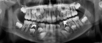 Рентген молочных зубов