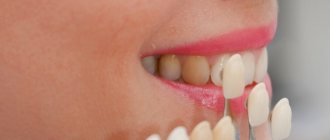 Dental restoration with veneers