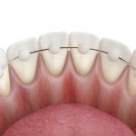 retainer orthodontist Moscow