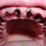 Blood clot after tooth extraction