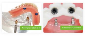 spherical and equatorial abutment of removable dentures