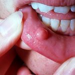 Шика на внутренней стороне губы