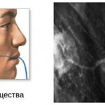 Сиалография с контрастированием: хронический сиалоаденит околоушной железы