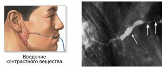 Sialography with contrast: chronic sialoadenitis of the parotid gland