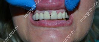 blue gums near the tooth