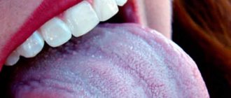 Blue coating on the tongue