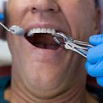 Сколько болит зуб после удаления нерва - Стоматология «Линия Улыбки