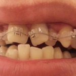 Скученность нижних зубов лечение без брекетов