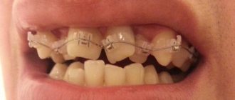 Скученность нижних зубов лечение без брекетов