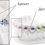 Components of braces