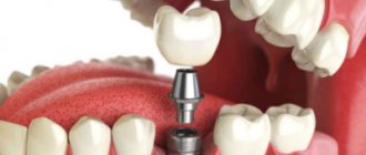 A special prosthesis for teeth - a crown. What is it, what kind of doctor makes and installs them? 