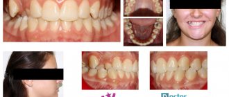 After a year and a half of treatment for transposition, it was possible to move the crowns and roots of the teeth to the correct position