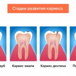 Стадии развития кариеса в картинках