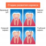 Stages of caries development in pictures