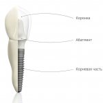 Structure of a dental implant