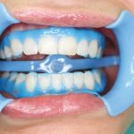 There are several ways to whiten teeth