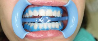 Существует несколько способов отбеливания зубов