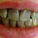 tetracycline teeth