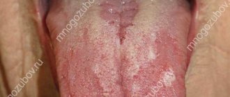 types of tongue irritation