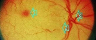 Thrombosis of the central retinal artery diagnostics