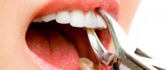 удаление дистопированного зуба