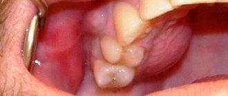 Removal of a tooth cyst