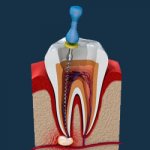 Удаление нерва - Стоматология Линия Улыбки