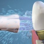 Implant care