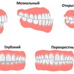 Виды дефектов окклюзии и методы их коррекции