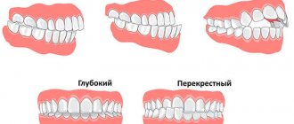 Виды дефектов окклюзии и методы их коррекции