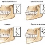 Виды правильного прикуса