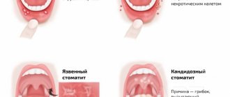 Types of stomatitis