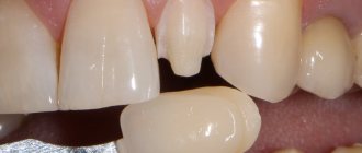 Veneers are thin plates that are attached to the surface of the teeth.