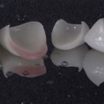 Ceramic veneers