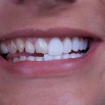Veneers pros and cons