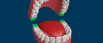 Inflammation of a wisdom tooth