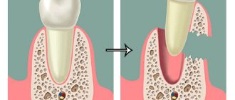 Восстановление зубного ряда