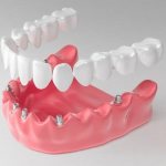 Возможные последствия имплантации зубов