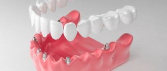 Possible consequences of dental implantation